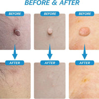 2 in 1 Skin Tag Remover Kit - Painless